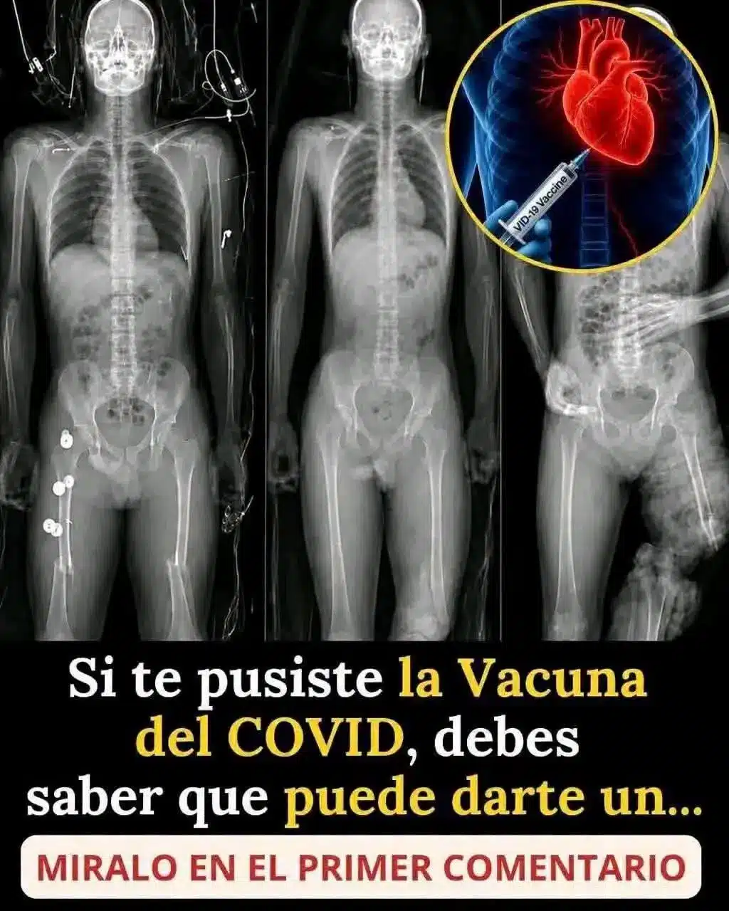 Alerta mundial para los vacunados contra COVID